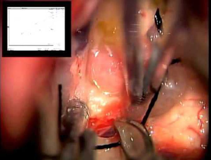 Interhemispheric transchoroidal approach to resect third ventricular teratoma
