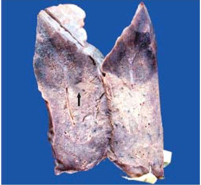 Haemorrhagic infarct lung