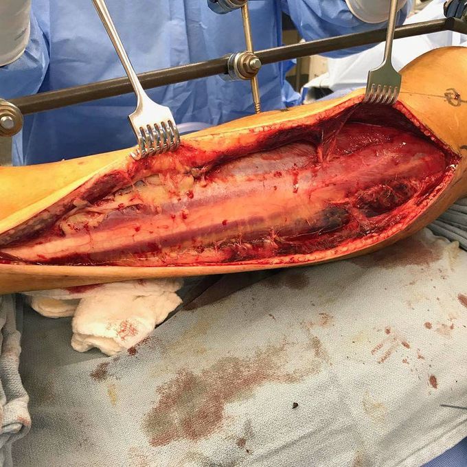 Compartment syndrome release