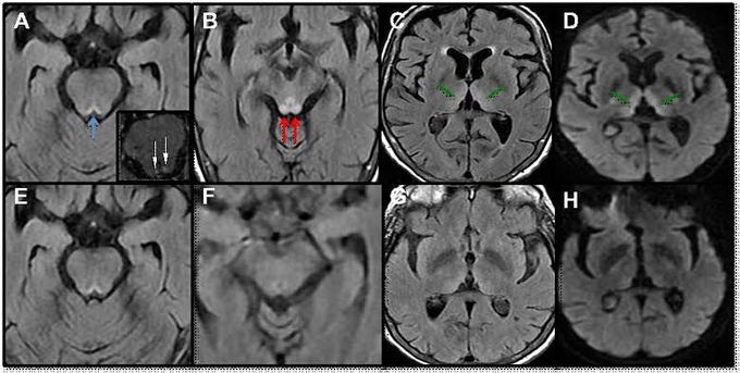 Wernickes encephalopathy