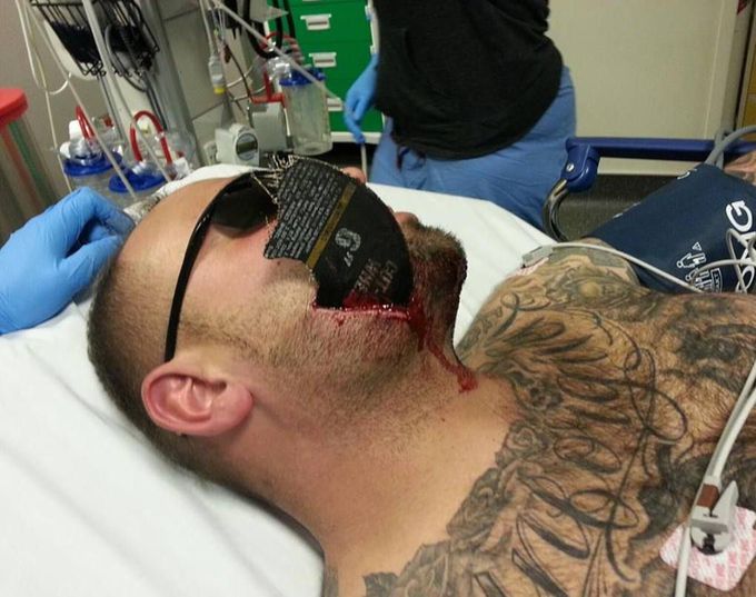 Angle grinder injury 