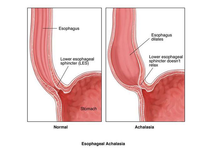 Esophageal achalasia