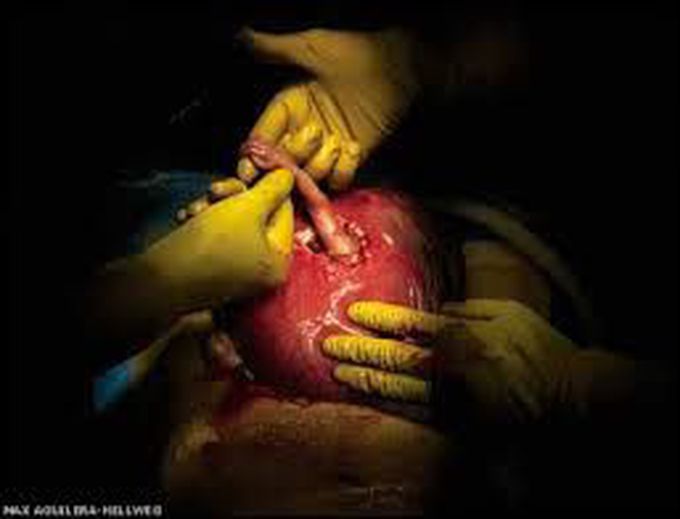 Feuds surgery