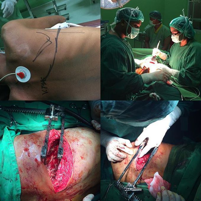 Thoracotomy