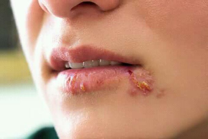 what are the disease???