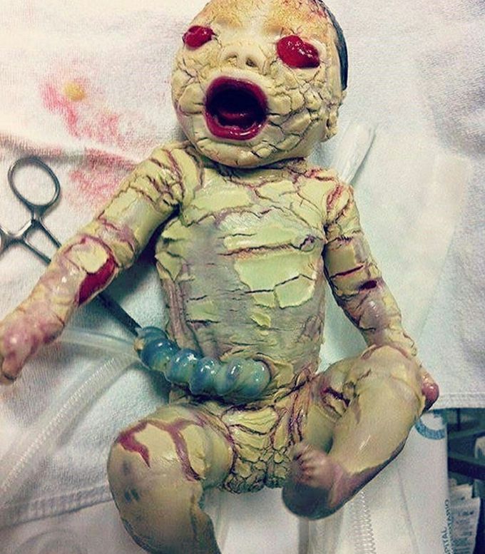 Here is a rare shot of a condition called ichthyosis
