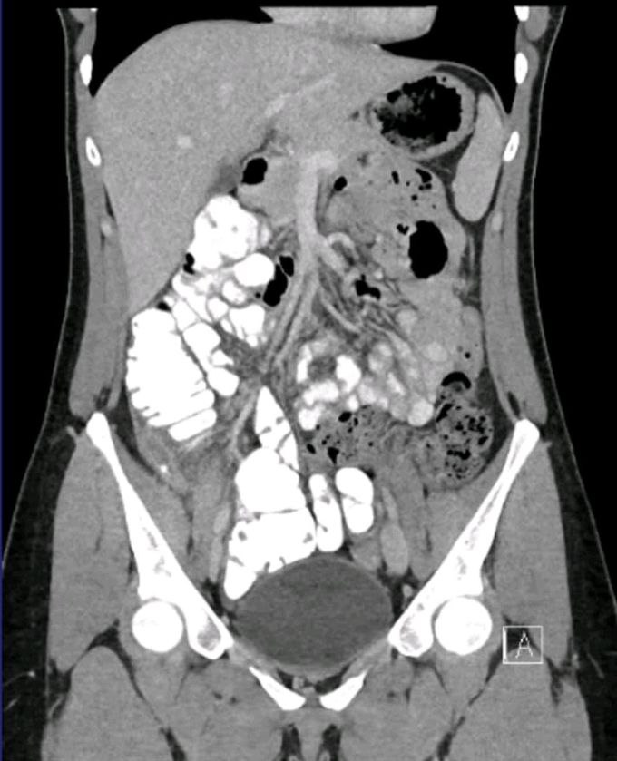 Abdominal ct