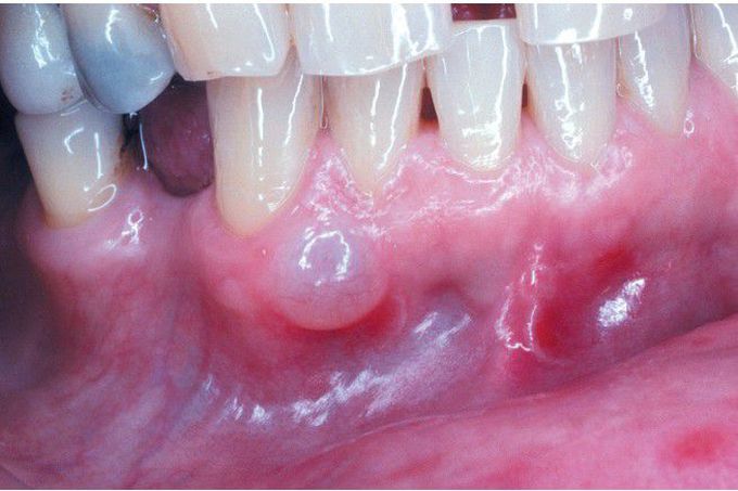 Gingival Cyst of the Adult