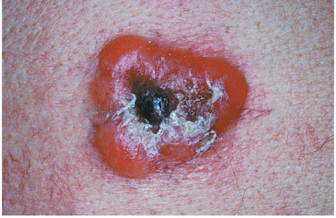 Mycosis Fungoides