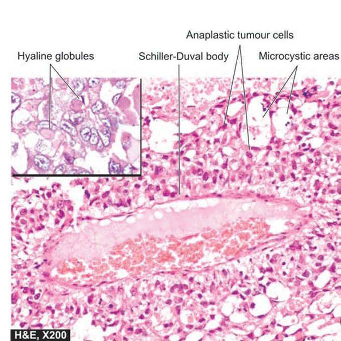 Yolk sac tumour testis.