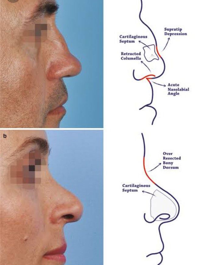 Saddle nose deals