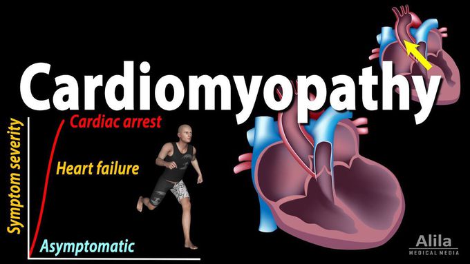 Cardiomyopathy