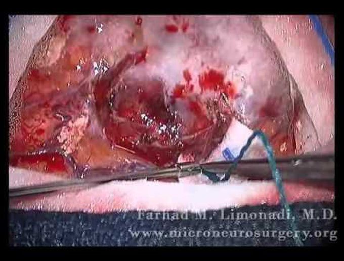 Short Clip of live surgery on Meningioma, Motor Cortex