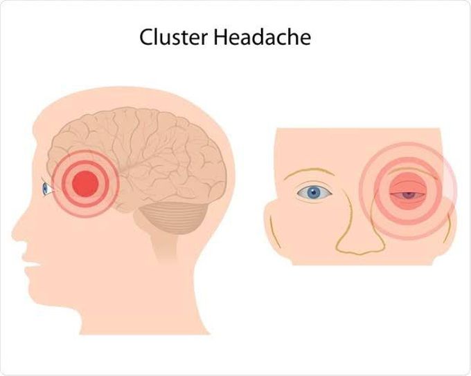 Cluster headache - MEDizzy