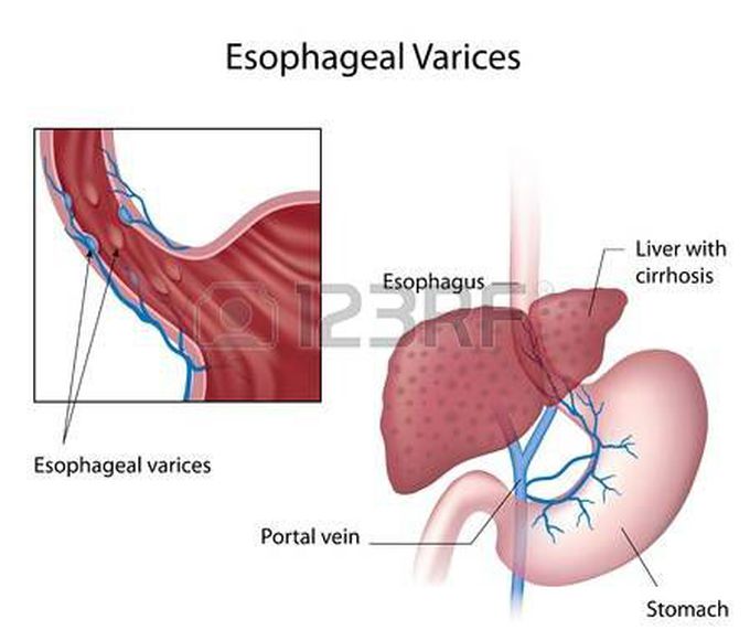 Portal Hypertension lead to esophageal varices