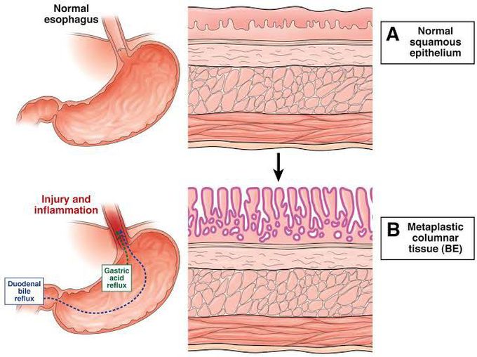 Barret Esophagus