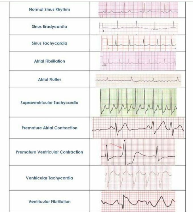 #ECG