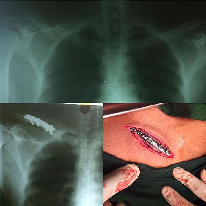 Clavicle fixation