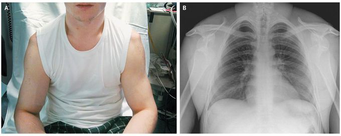 Bilateral Anterior Shoulder Dislocation