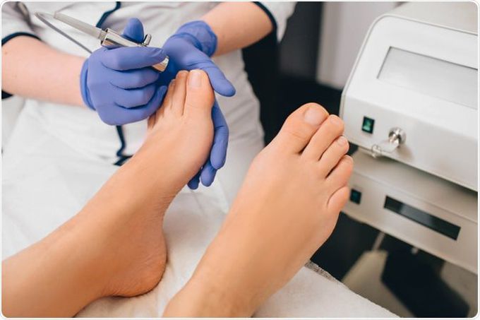 Treatment for Onychomycosis