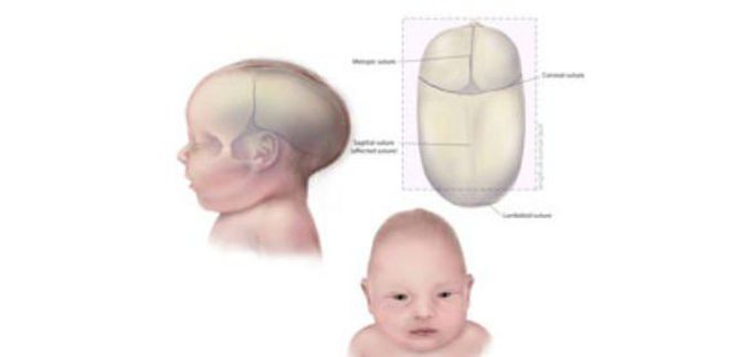 Craniosynostosis