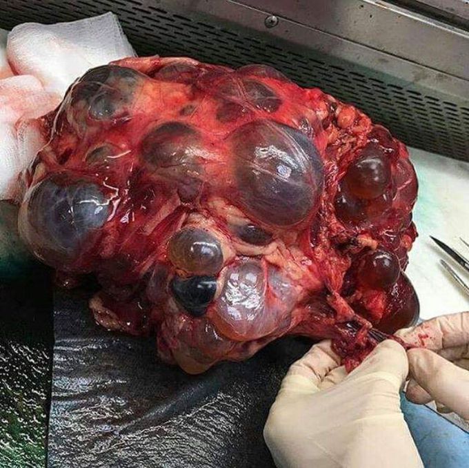 PKD- Polycystic Kidney Disease