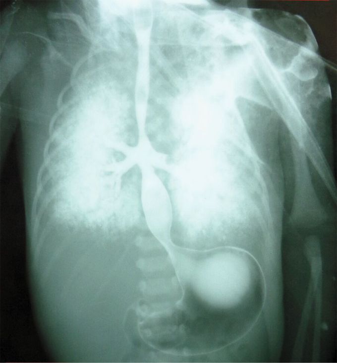 Tracheal Agenesis with Bronchoesophageal Fistula