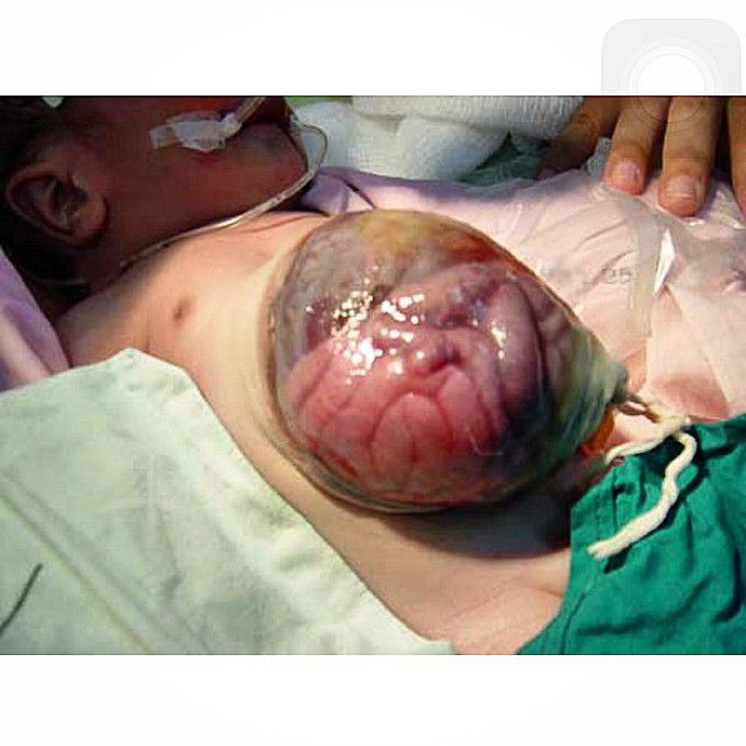 Omphalocele