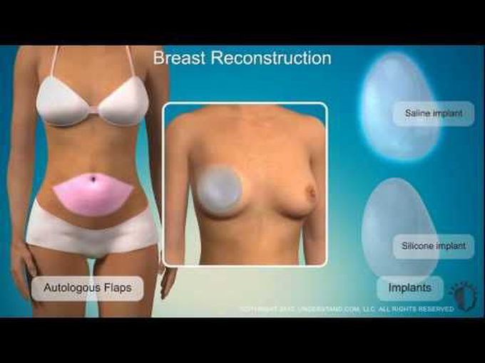 Breast Reconstruction- Animation