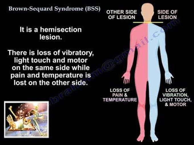 Brown sequard syndrome causes