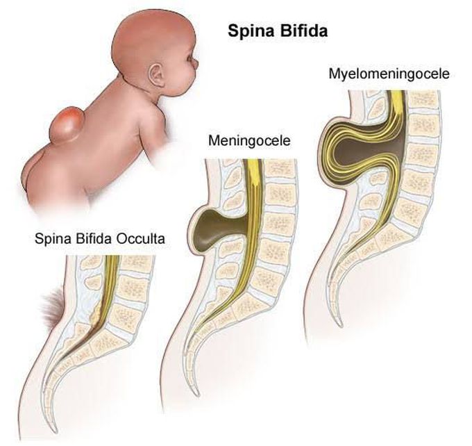 Myelomeningocele vs spina bifida