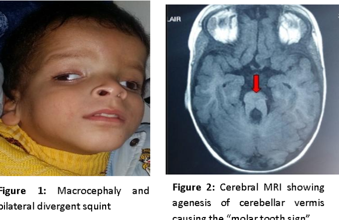 Joubert Syndrome: A Rare Developmental Disorder of Brain