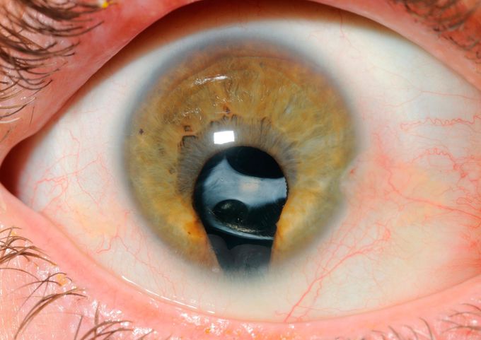 Coloboma of the Iris