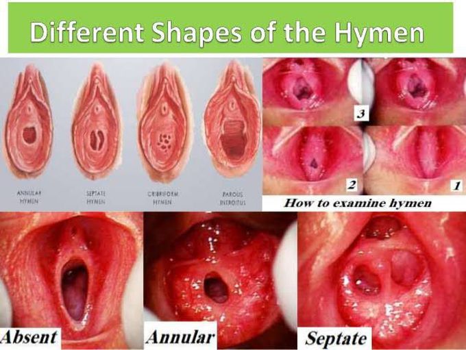 Different shapes of Hymen
