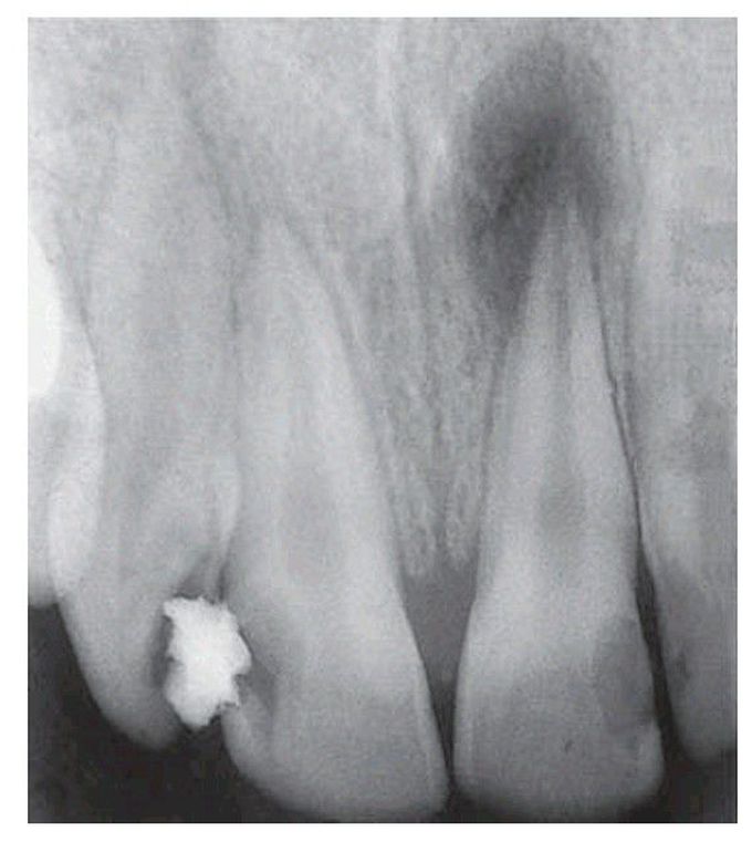 Chronic apical abscess