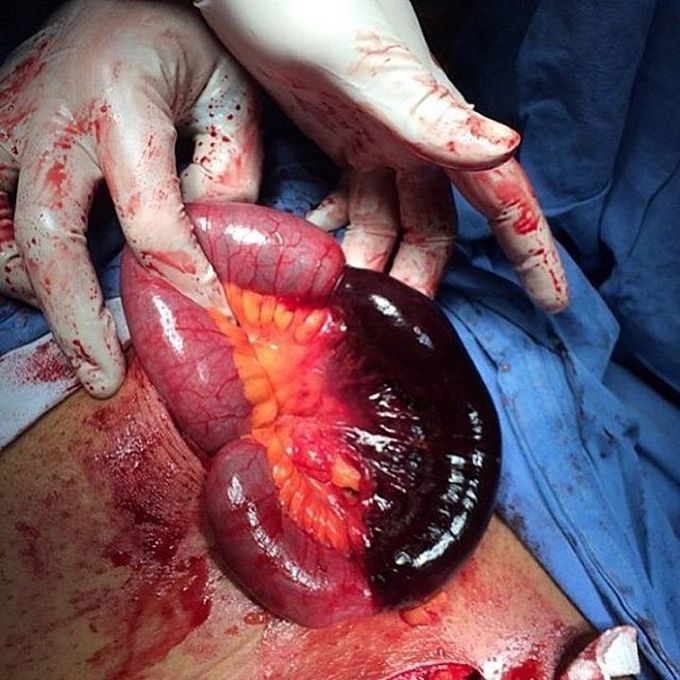 Gangrenous necrosis of the small intestine due to volvulus! 