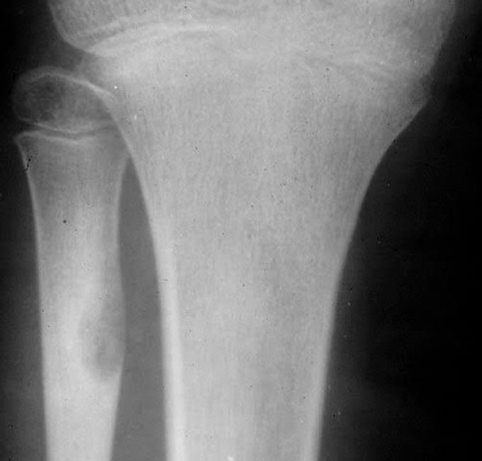 Dignosis of osteoid osteoma