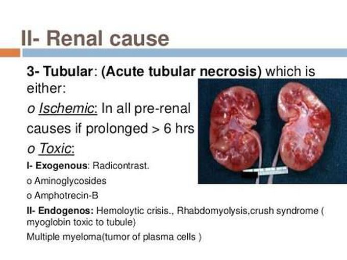 Acute Tubular Necrosis : Reversible kidney injury and most - MEDizzy