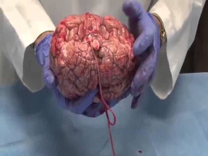 Fresh Removed Brain Autopsy