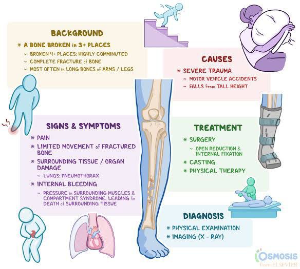 Comminuted fracture - MEDizzy