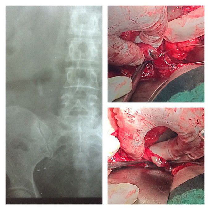 Ureteric stone on right ureter