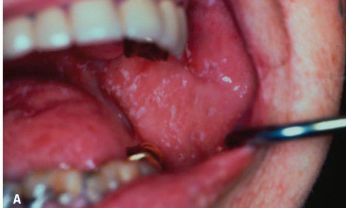 Early oral thrush