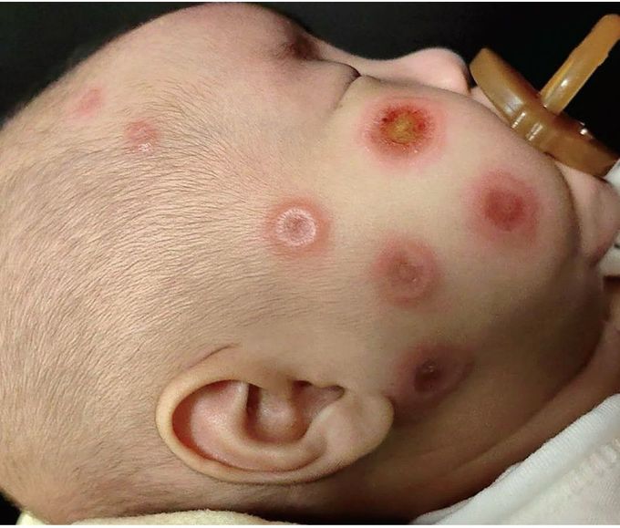 Newborn Lupus Symptoms