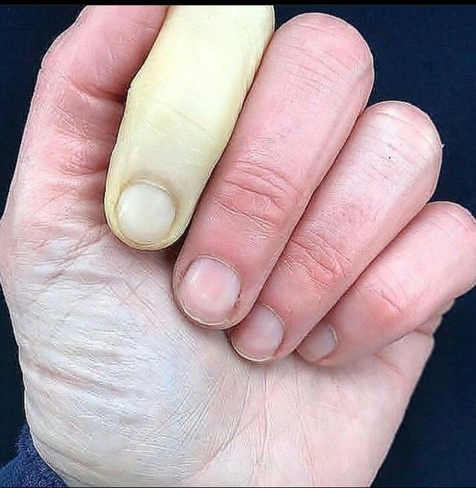 Raynaud's Phenomena