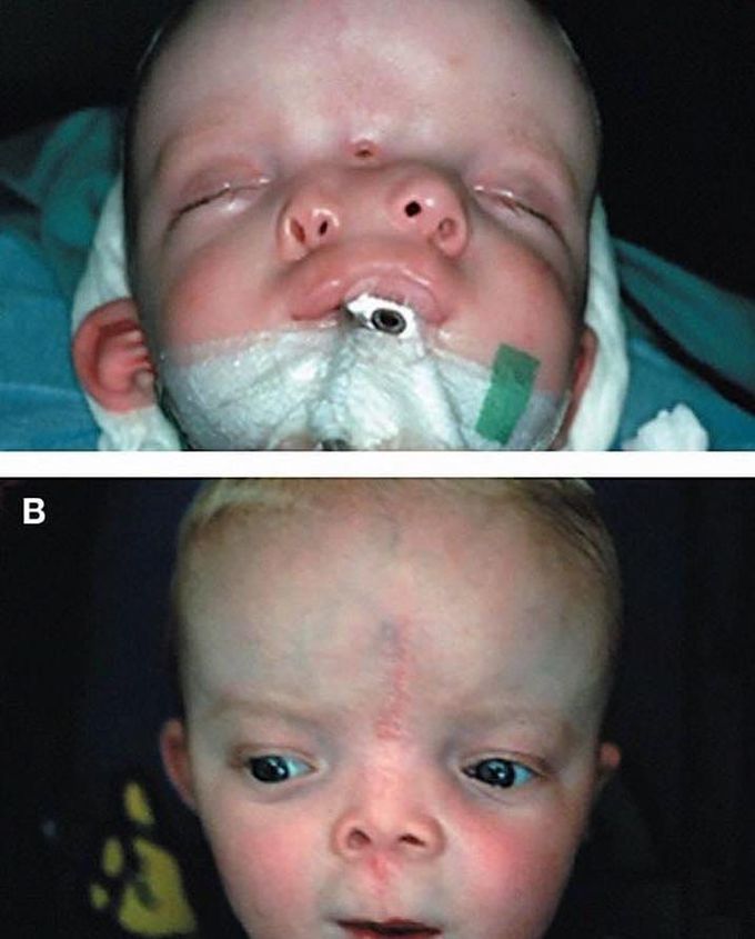 Succesful surgical outcome of #diprosopus (two-faced) baby.