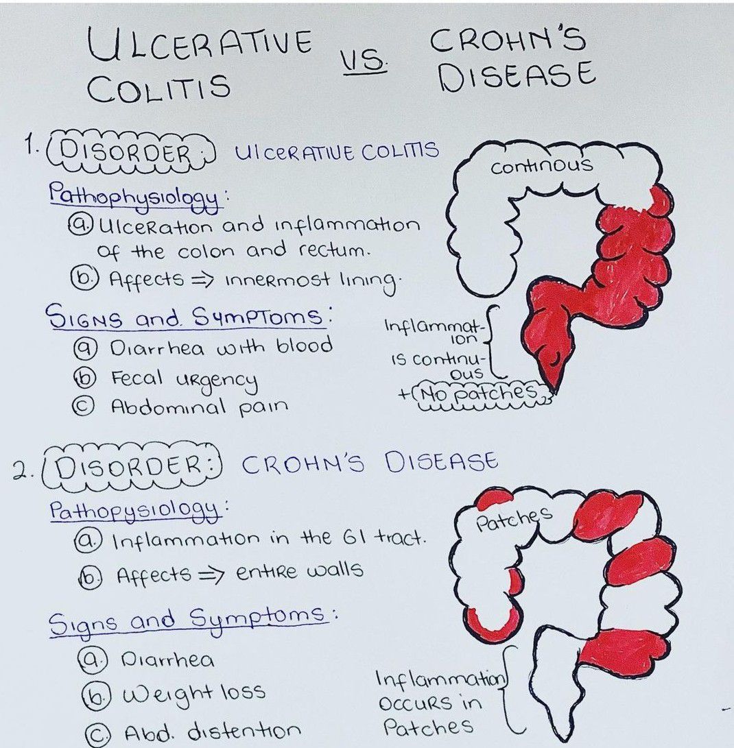 Ulcerative Colitis Vs Crohn s Disease MEDizzy