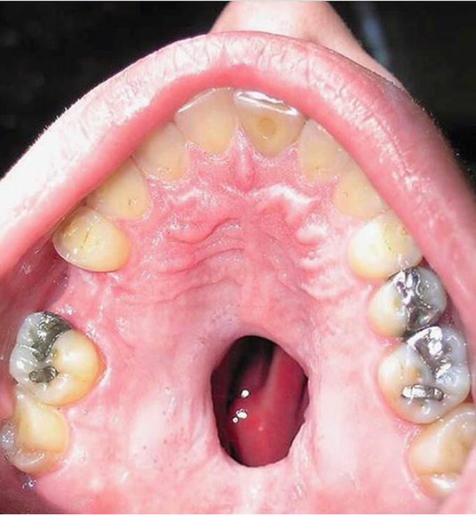 A side effect of cocaine use!
