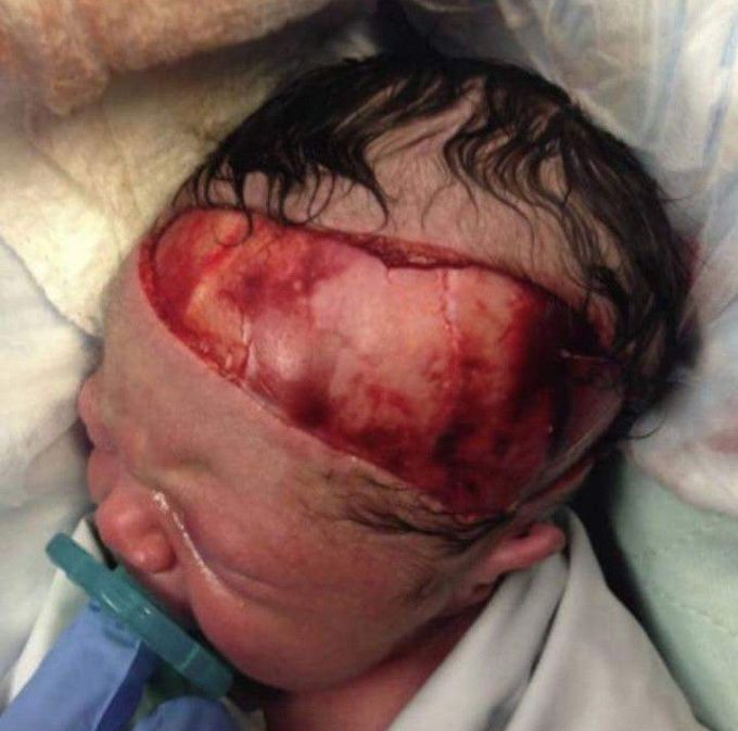Severe scalp lacreation in a newborn