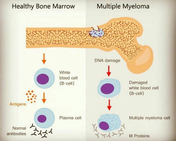 Myeloma nd healthy bone marrow