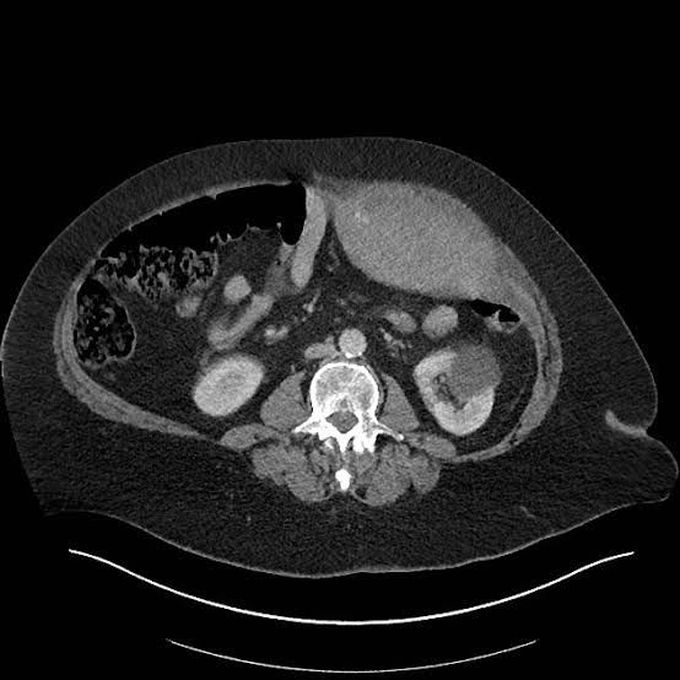 Rectus sheath hematoma